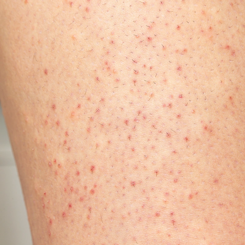 Folliculitis Treatment Phoenix, AZ Banner