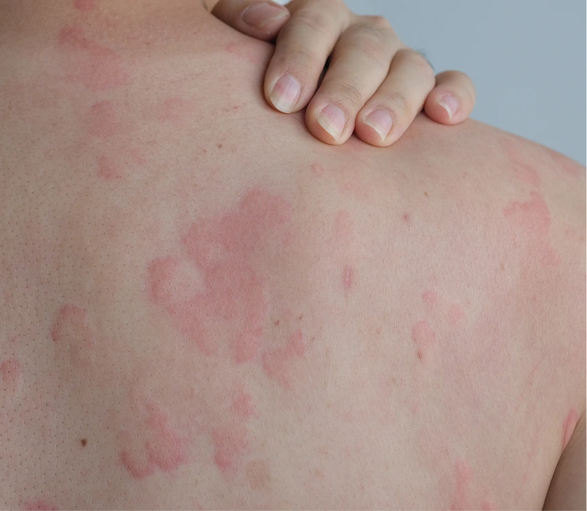 Hives Treatment Phoenix, AZ Banner