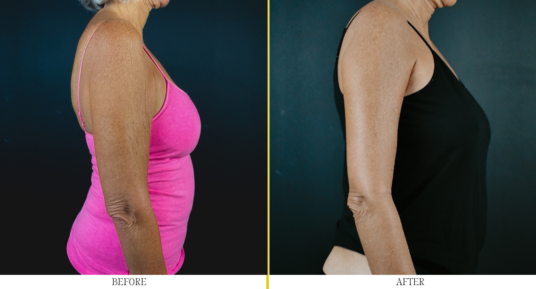 Brachioplasty - Case 3 (3)