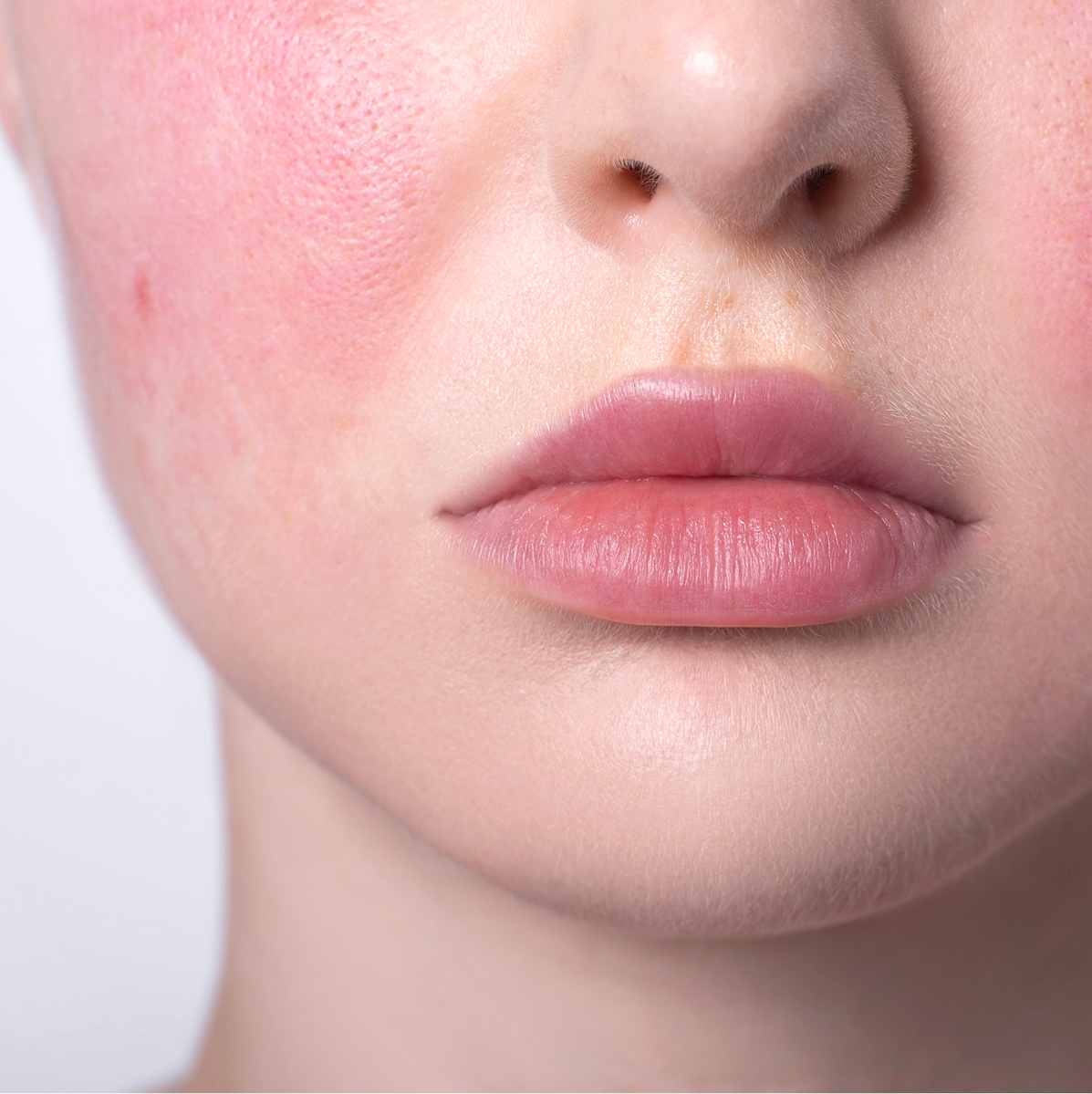 Rosacea Treatment Phoenix, AZ Banner