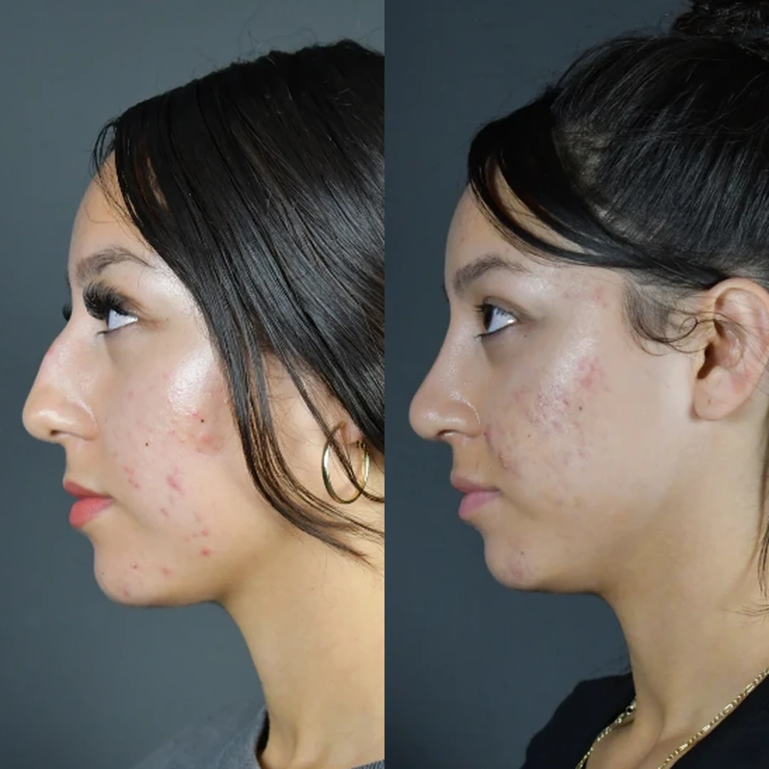 Rhinoplasty Case 14 before and after, side profile
