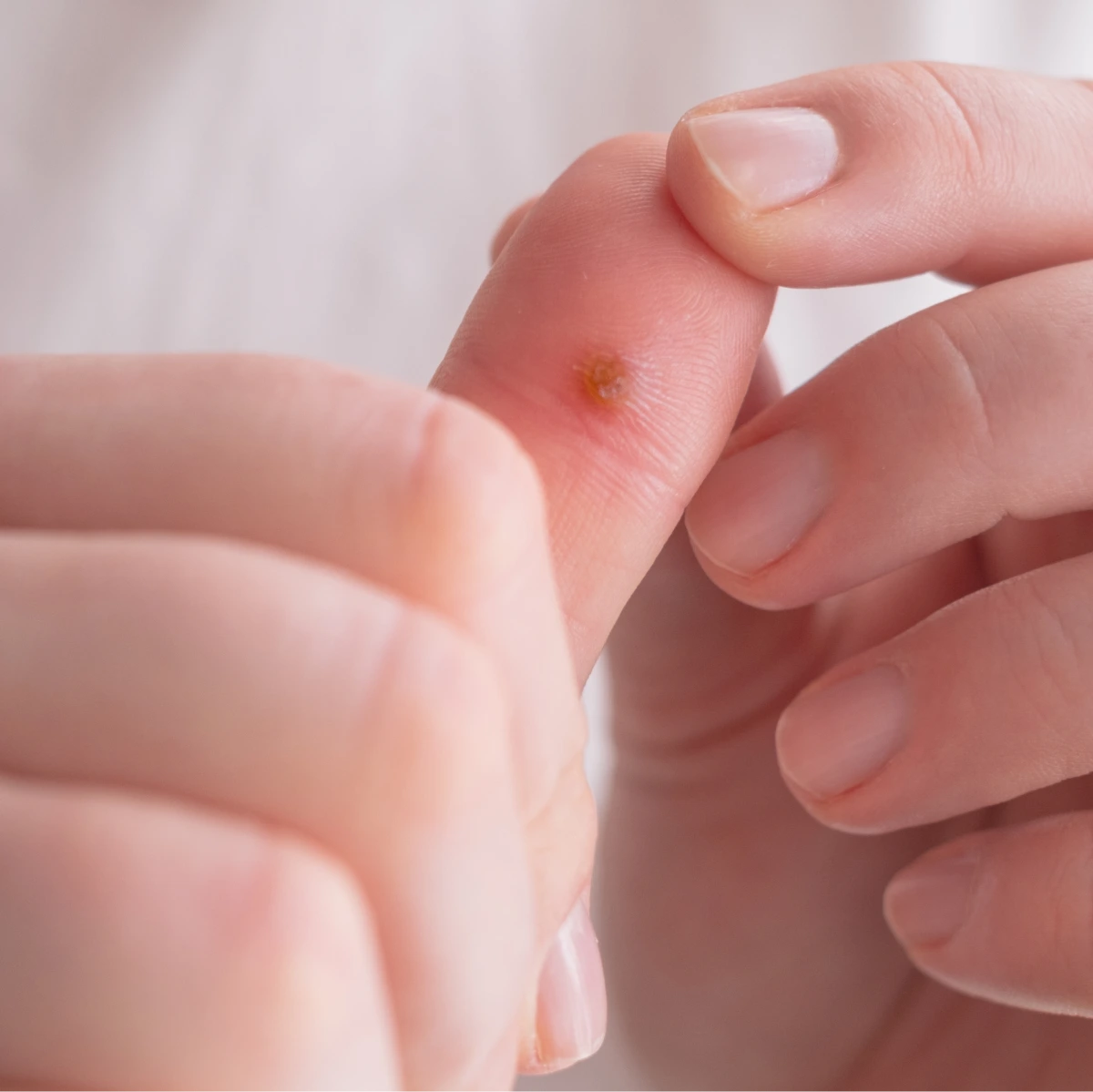 Warts Treatment in Phoenix, AZ Banner