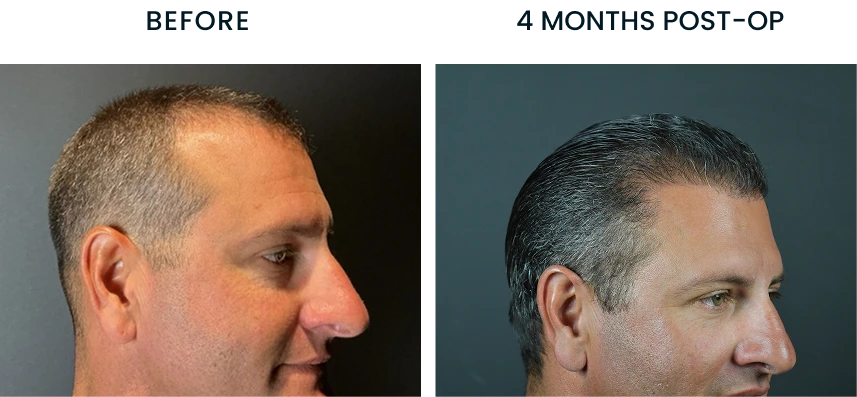 Before and after comparison showing male patient's profile before surgery and 4 months post-op