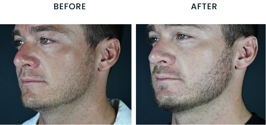 Before and after comparison of male patient's profile showing facial contours