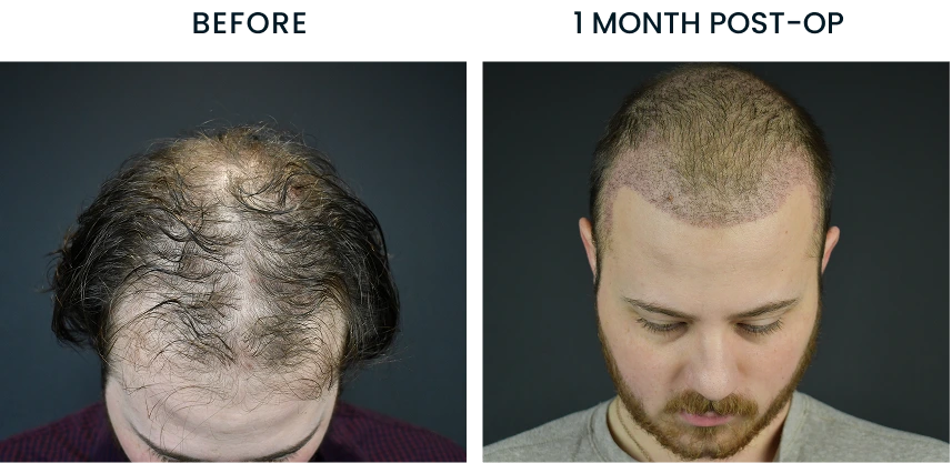 Before and after comparison showing male patient's hair growth before surgery and 1 month post-op