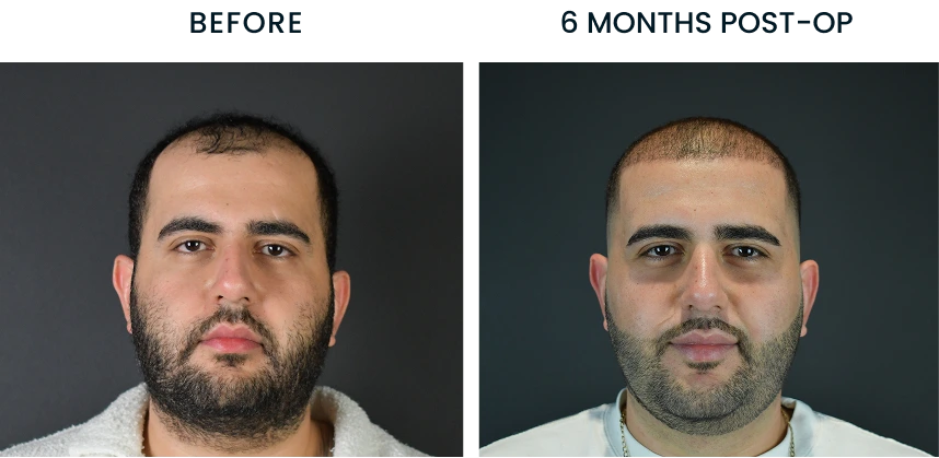 Before and after comparison showing male patient's hairline before surgery and 6 months post-op