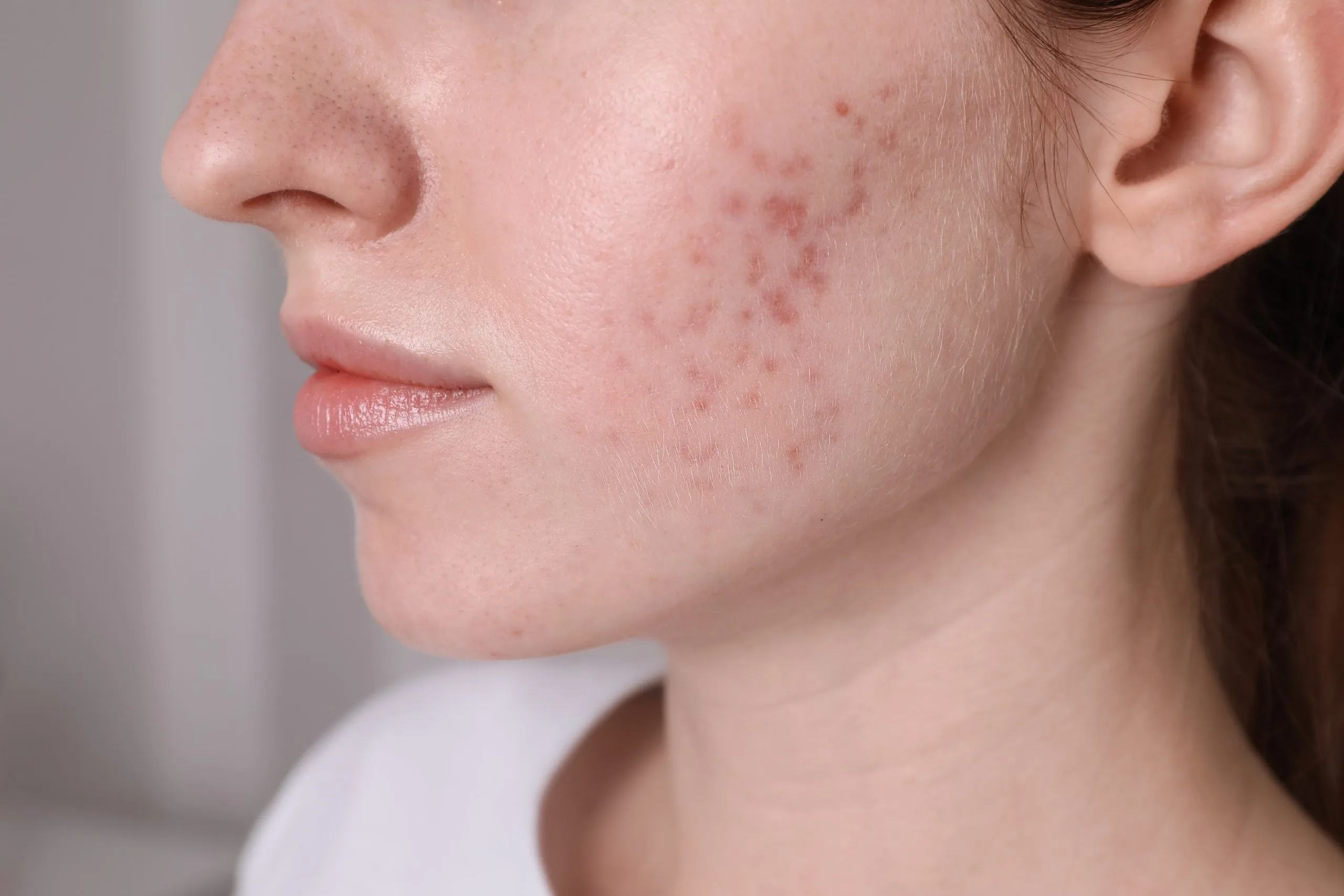 Side profile of person with acne and red spots across cheek and jawline