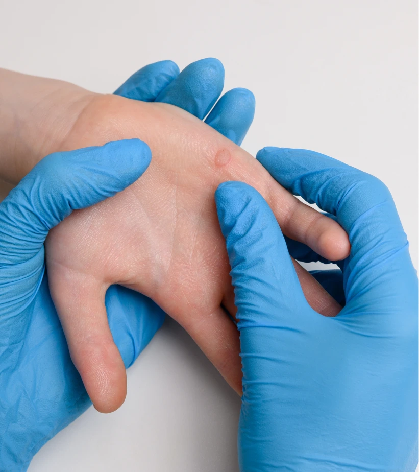 Healthcare provider wearing blue gloves examining a wart on patient's hand
