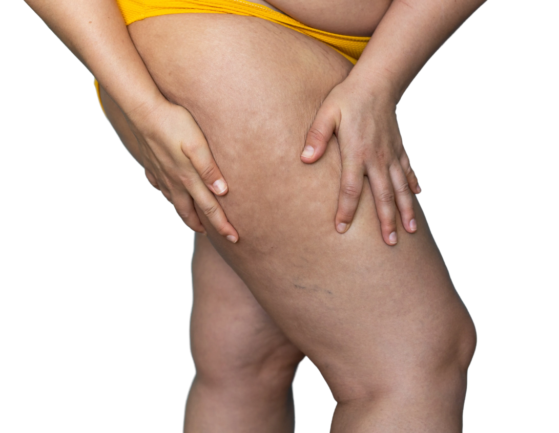 Person's legs and thighs showing lipedema with characteristic swelling and tissue texture