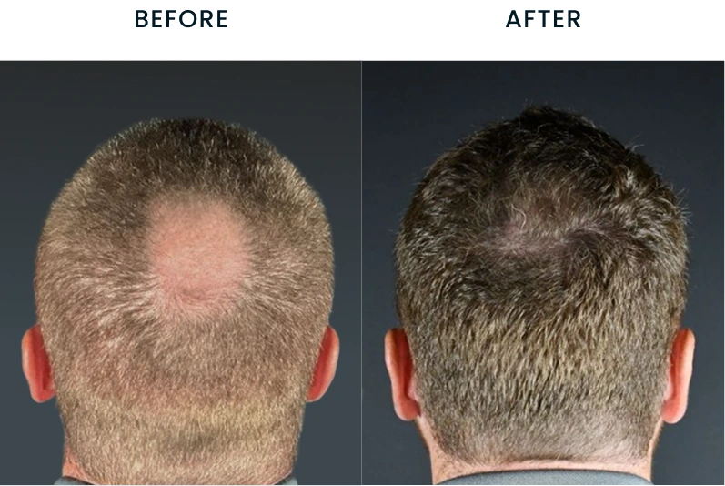 Before and after hair transplant results showing increased hair density on the crown and back of the head