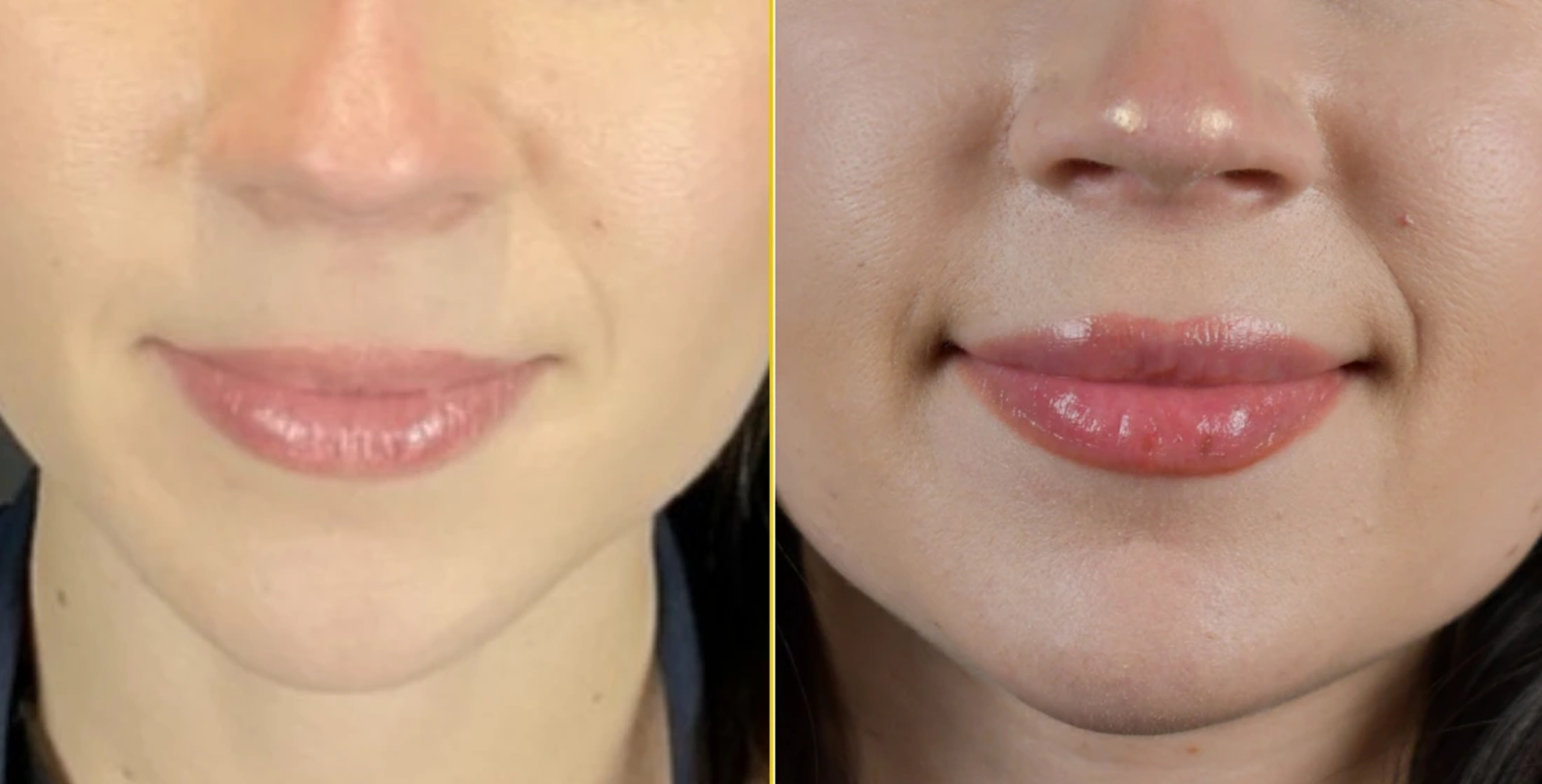 Before and after Juvederm lip augmentation showing fuller, more defined lips