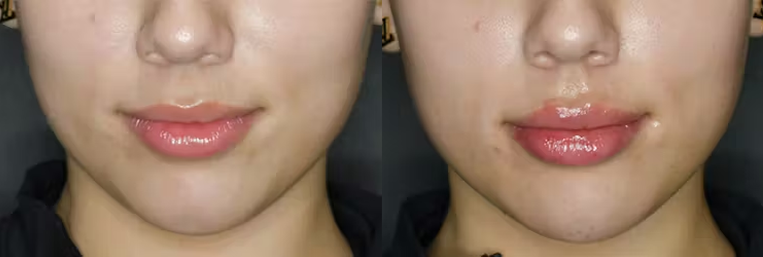 Before and after comparison of lip augmentation with fuller, more defined lips on the right