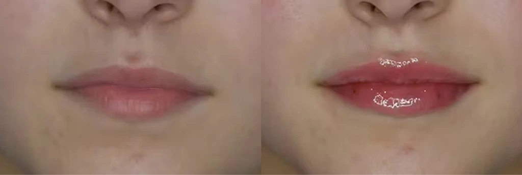 Before and after comparison of lip augmentation with Juvederm showing fuller lip volume and definition