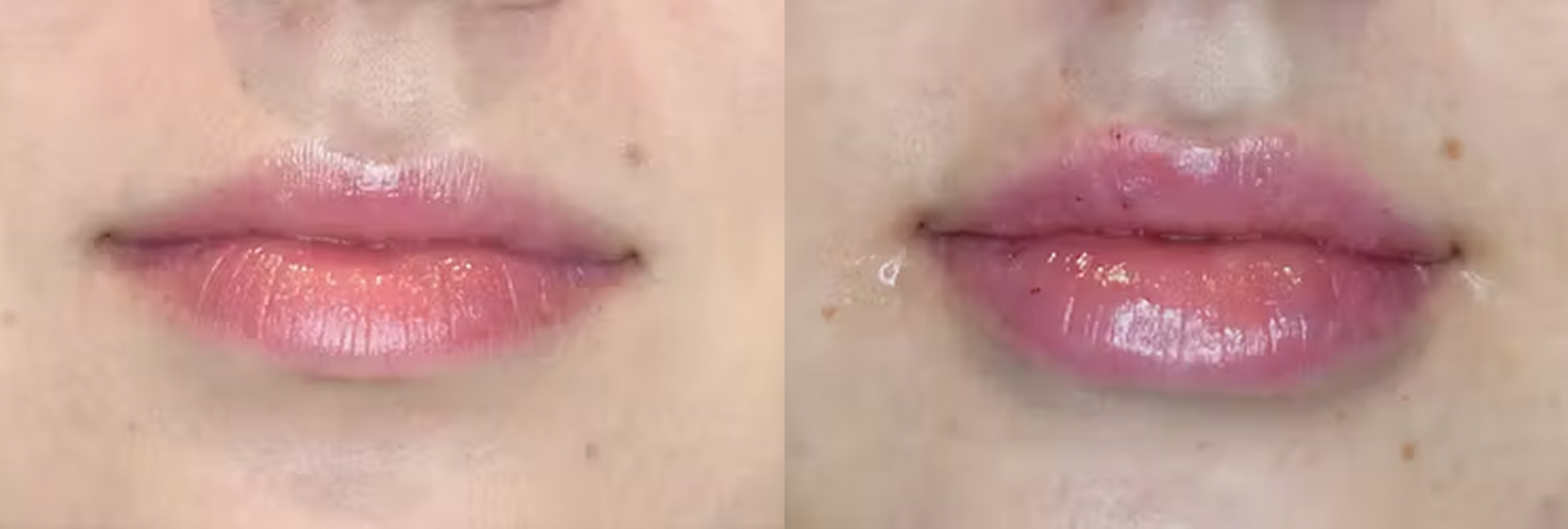 Before and after Juvederm lip enhancement showing fuller, more defined lips with increased volume