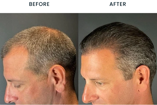 Before and after hair transplant results showing increased hair density on the crown and hairline