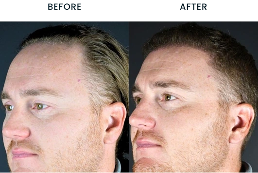 Hair transplant before and after comparison showing increased hair density on the scalp