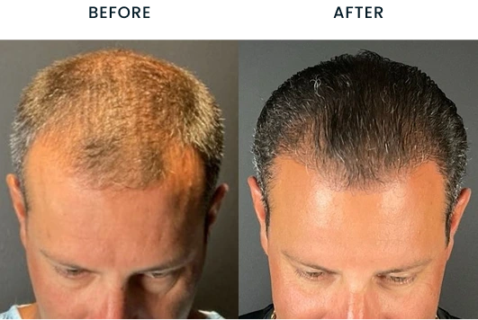 Before and after hair transplant results showing increased hair density on the crown