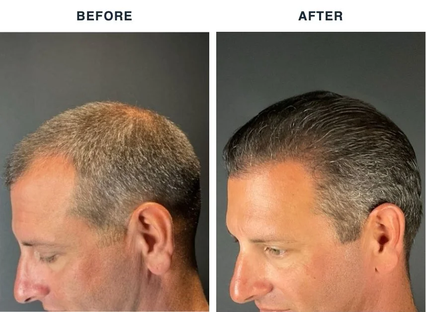 Before and after hair restoration results showing increased hair density and coverage from side profile view