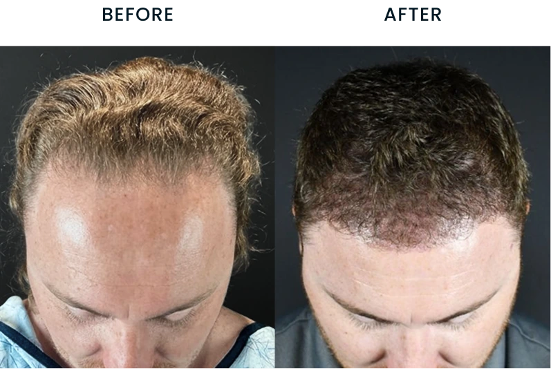 Hair transplant before and after: thinning hairline before, fuller hair coverage after treatment