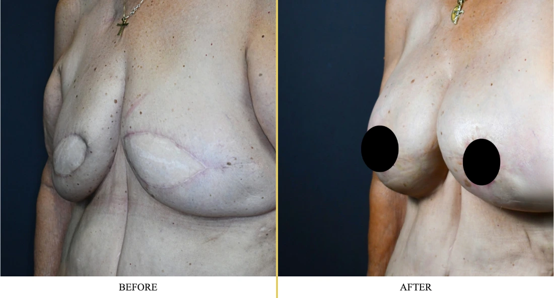 Breast reconstruction before and after comparison showing improved symmetry and contour