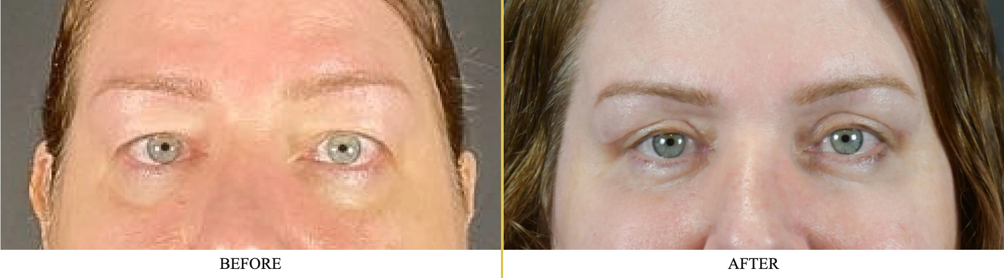 Before and after blepharoplasty case 12: left shows drooping upper eyelids, right shows lifted, more open eyes