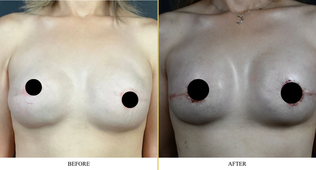 Breast reconstruction before and after comparison showing surgical results with patient privacy protection