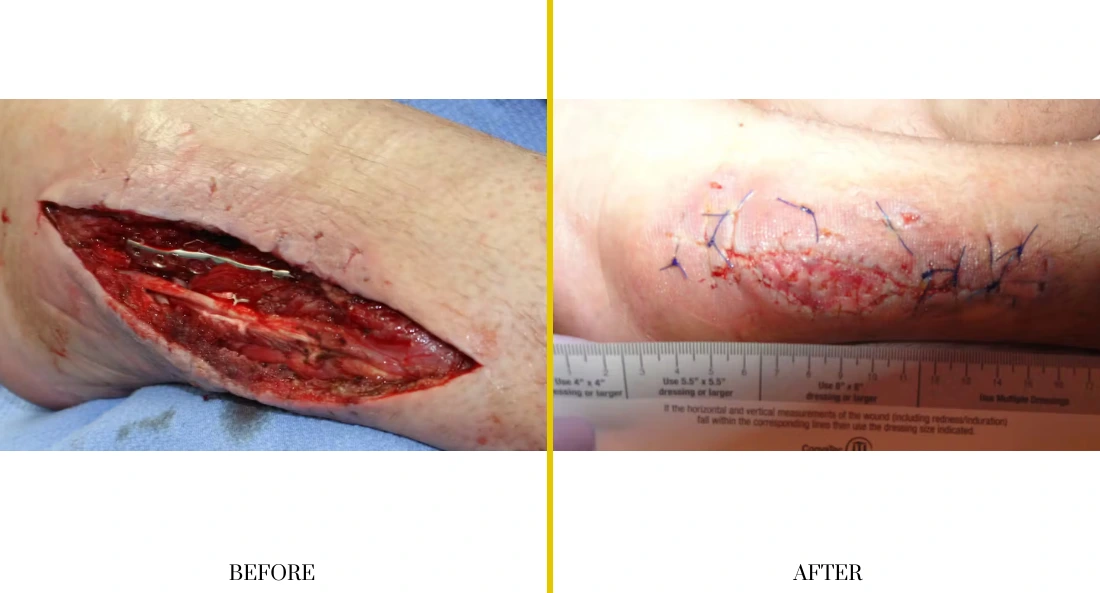 Extremity Reconstruction (24)