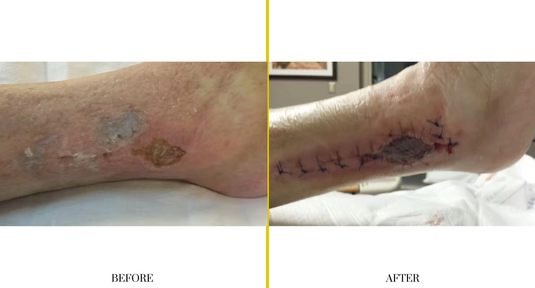 Extremity Reconstruction (44)