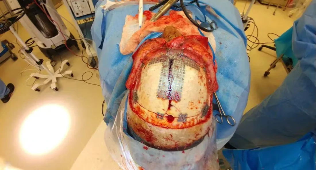 Skull Reconstruction and Cranioplasty (14)