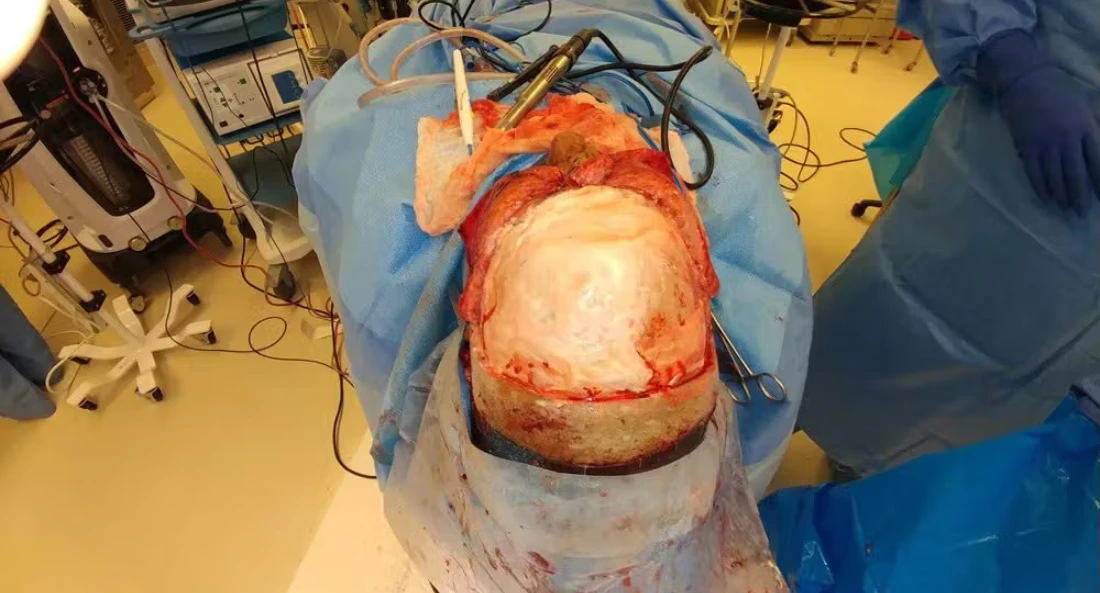 Skull Reconstruction and Cranioplasty (16)