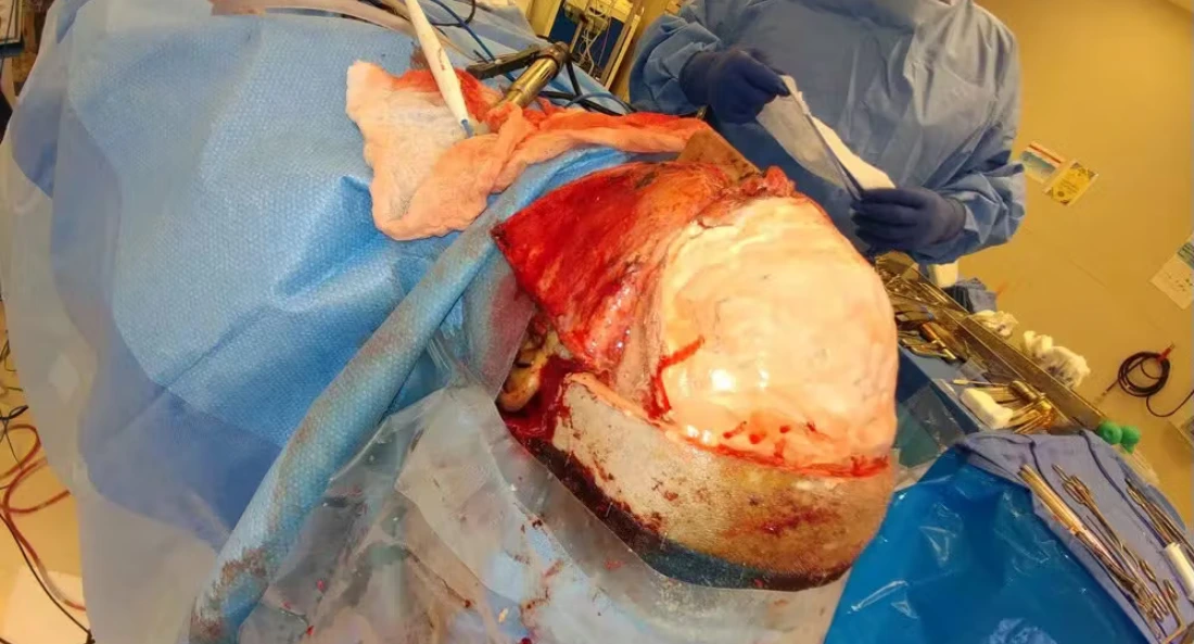 Skull Reconstruction and Cranioplasty (17)