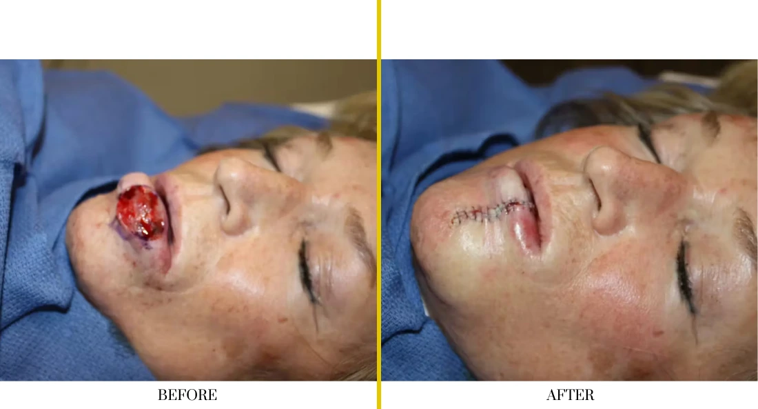 Skull Reconstruction and Cranioplasty (32)