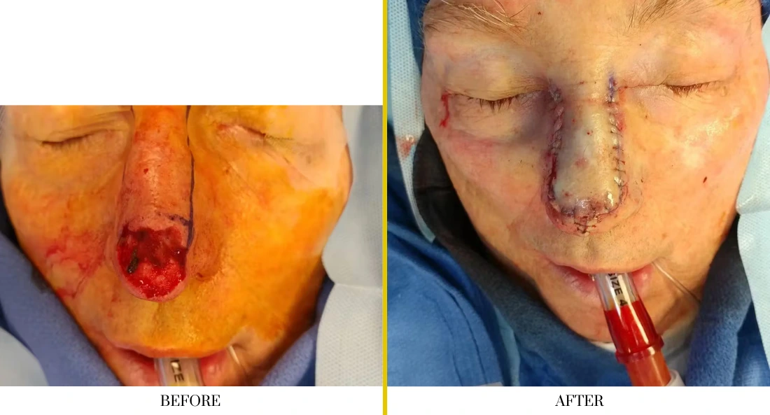Skull Reconstruction and Cranioplasty (34)