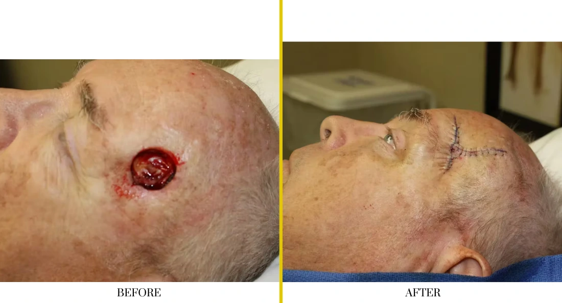 Skull Reconstruction and Cranioplasty (37)