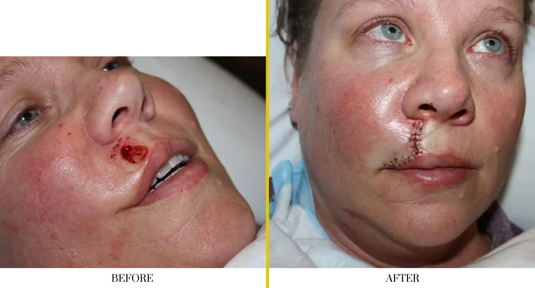 Skull Reconstruction and Cranioplasty (39)