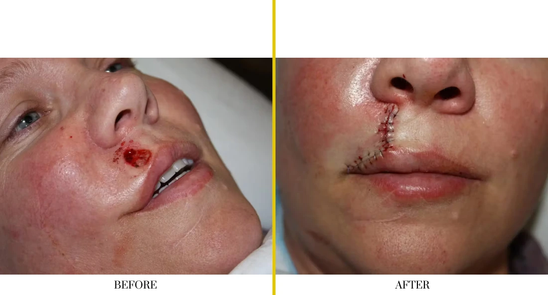 Skull Reconstruction and Cranioplasty (40)