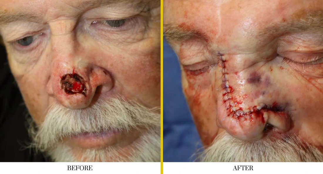 Skull Reconstruction and Cranioplasty (56)