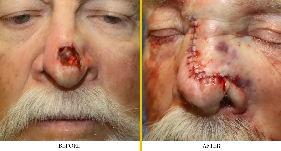 Skull Reconstruction and Cranioplasty (57)