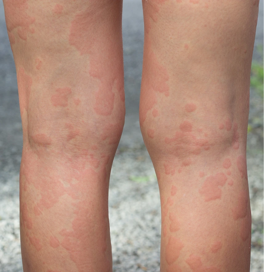 Hives Care in Phoenix, AZ Banner