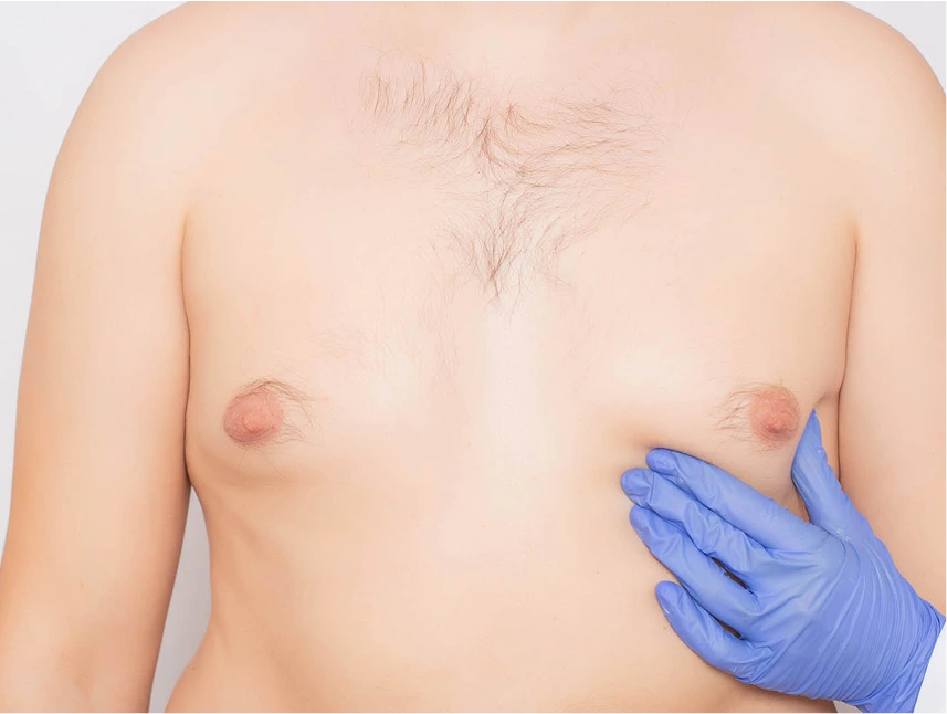 Symptoms of Gynecomastia Banner