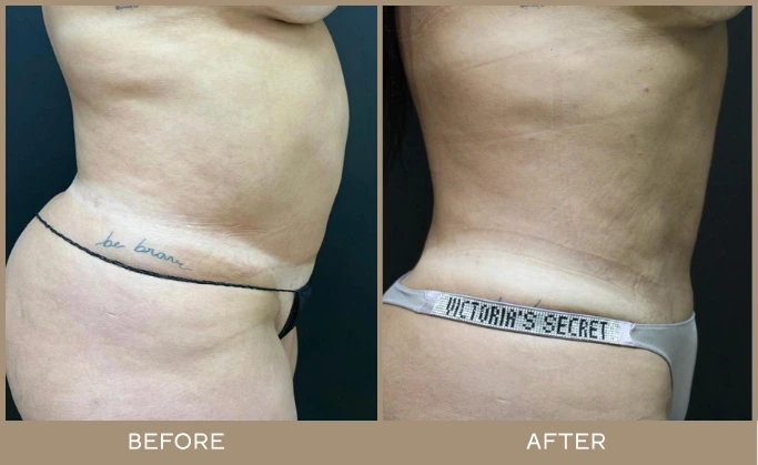 regeneris medspa Lipo 17.1