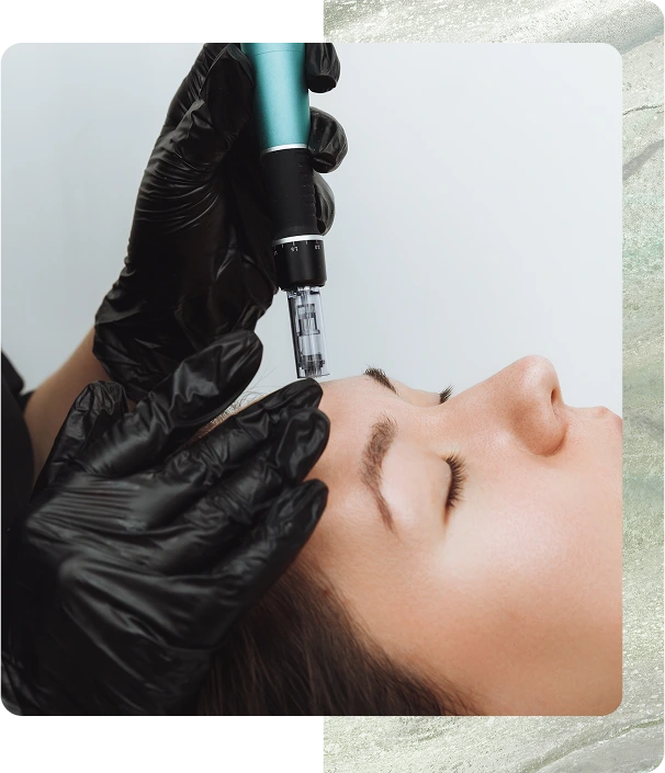 Are You Eligible for Microneedling? Banner