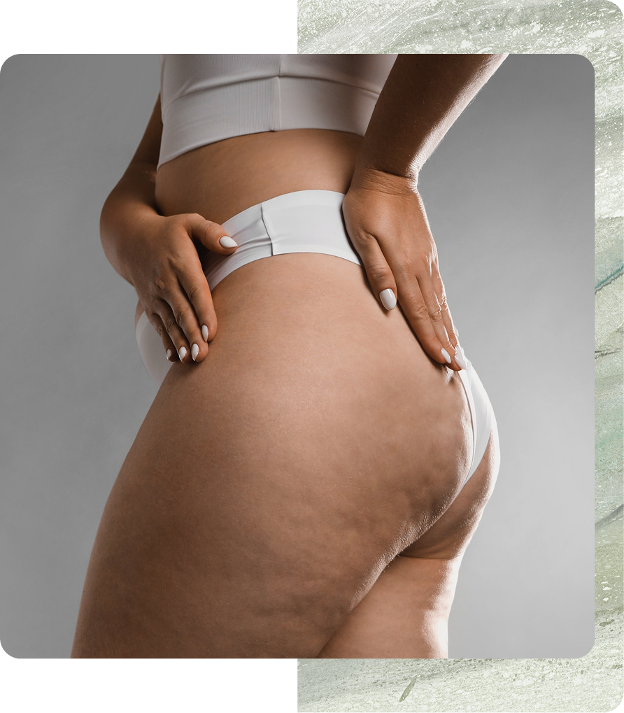 Person's hands examining buttocks and thighs from behind, wearing white briefs