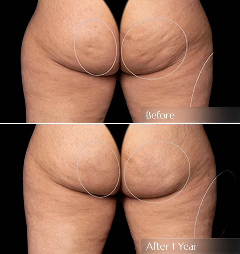 Before and after comparison of buttocks showing cellulite reduction after 1 year of treatment