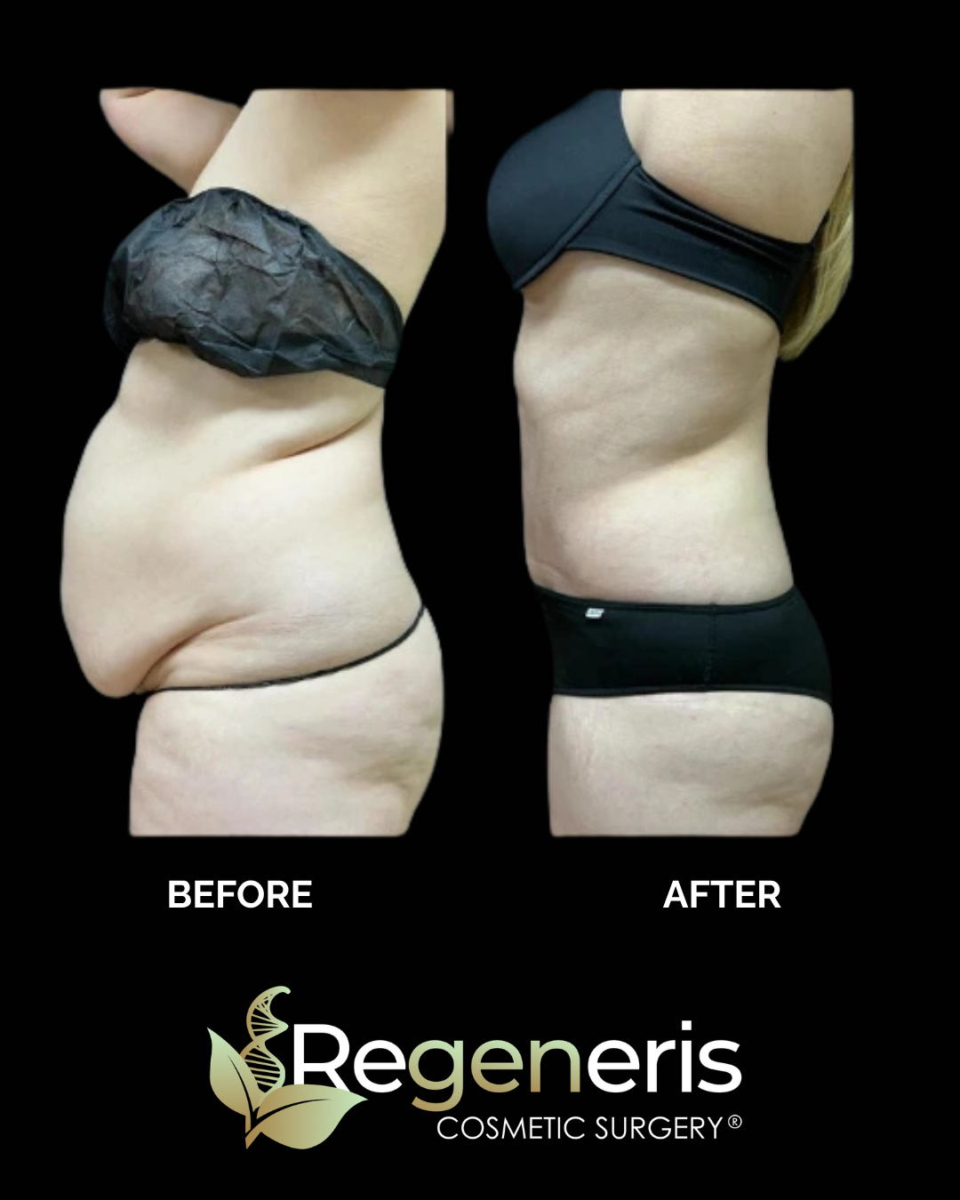 liposuction + renuvion case 20