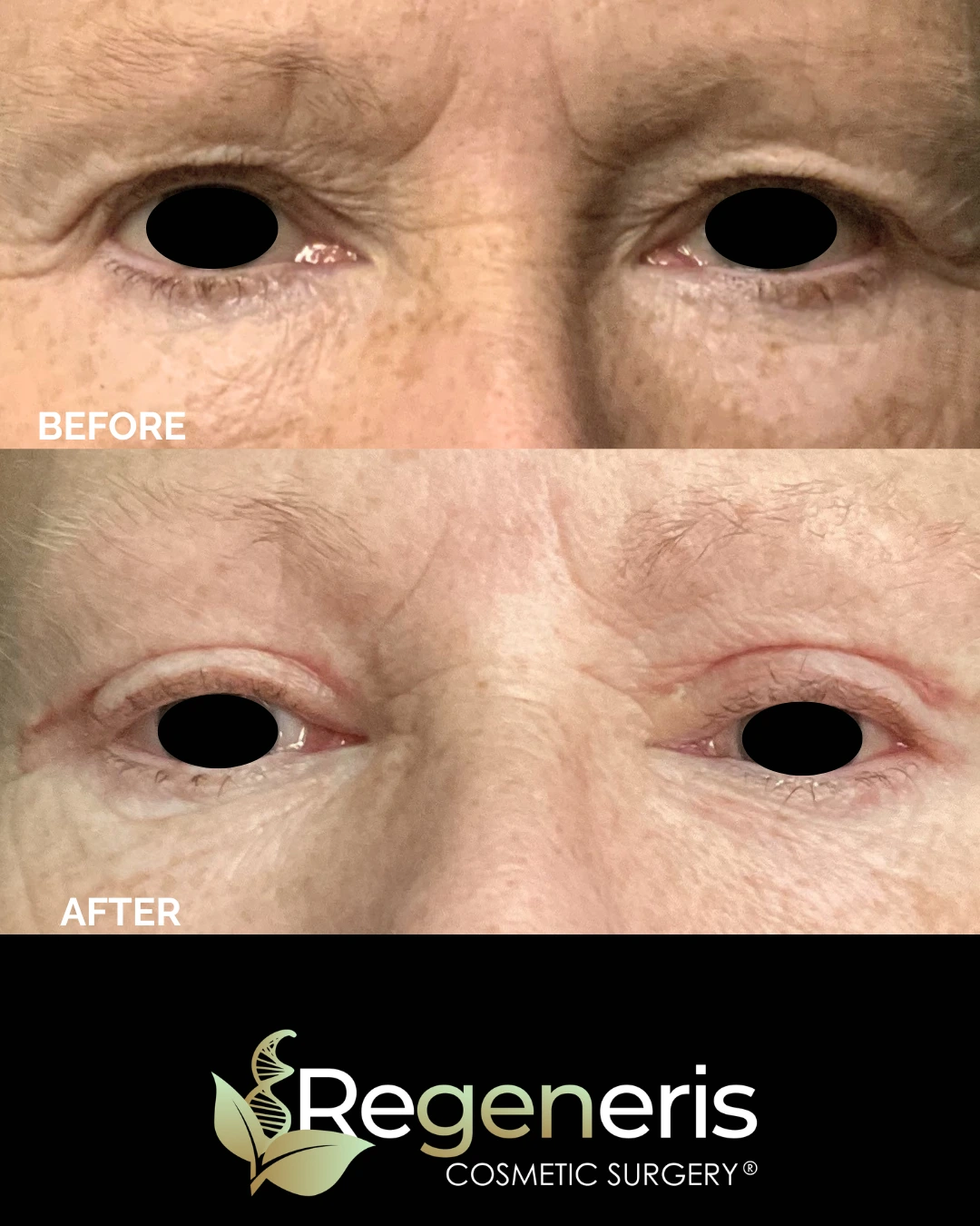 Before and after eyelid surgery comparison showing reduced upper eyelid drooping and puffiness with Regeneris Cosmetic Surgery logo