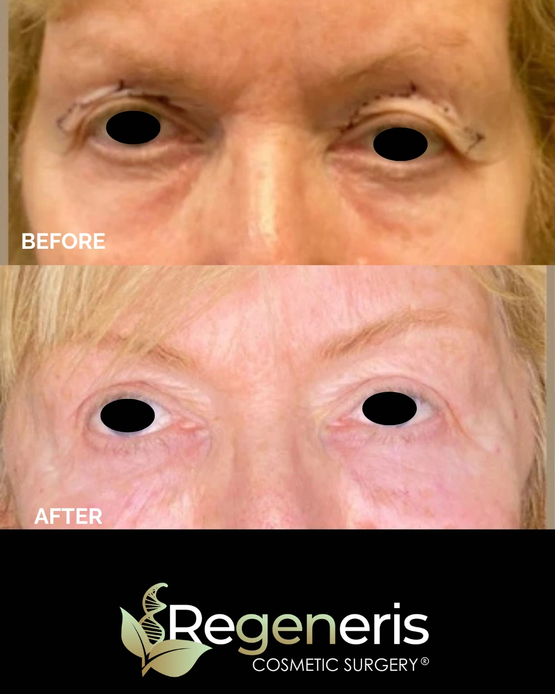 Before and after eyelid surgery showing improved eyelid contour and reduced under-eye bags with Regeneris Cosmetic Surgery logo
