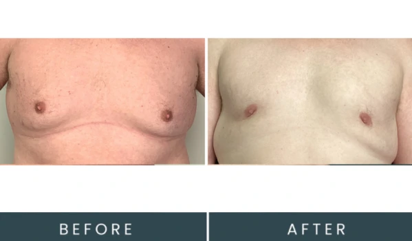Before and after frontal view showing chest contour treatment results