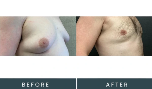 Before and after angled view comparison of male chest contouring treatment results