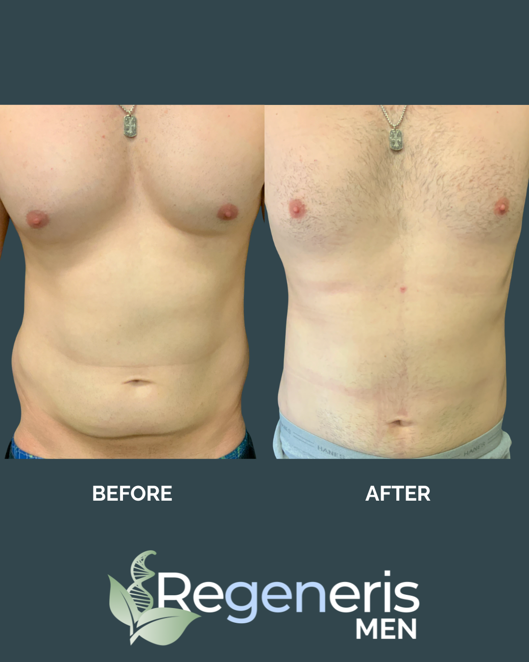 liposuction-case-1-3